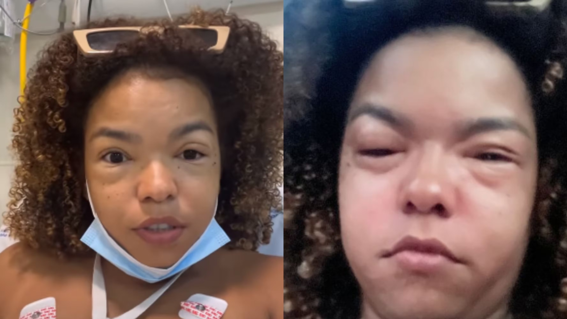 Médica explica reação alérgica que deixou Jeniffer Nascimento irreconhecível: “Quando há risco…’