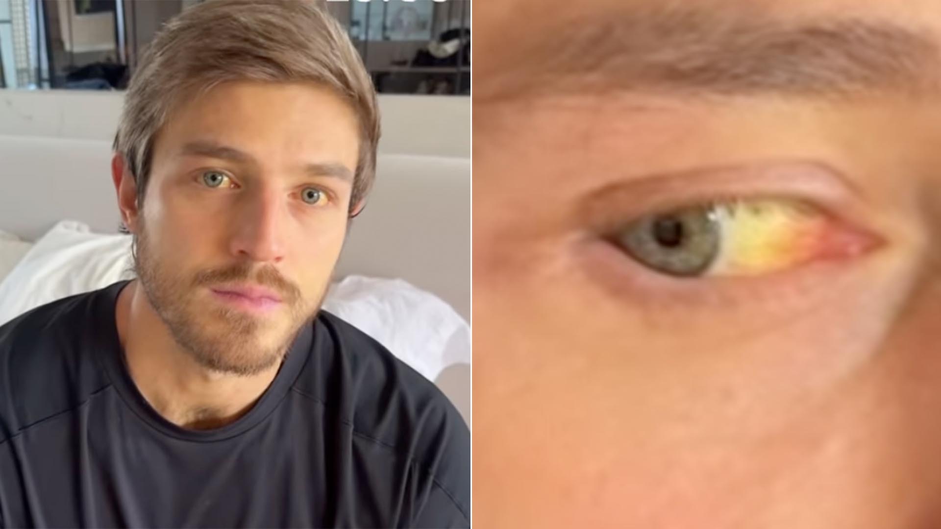 Namorado de Juliette surge com os olhos amarelos após alta hospitalar