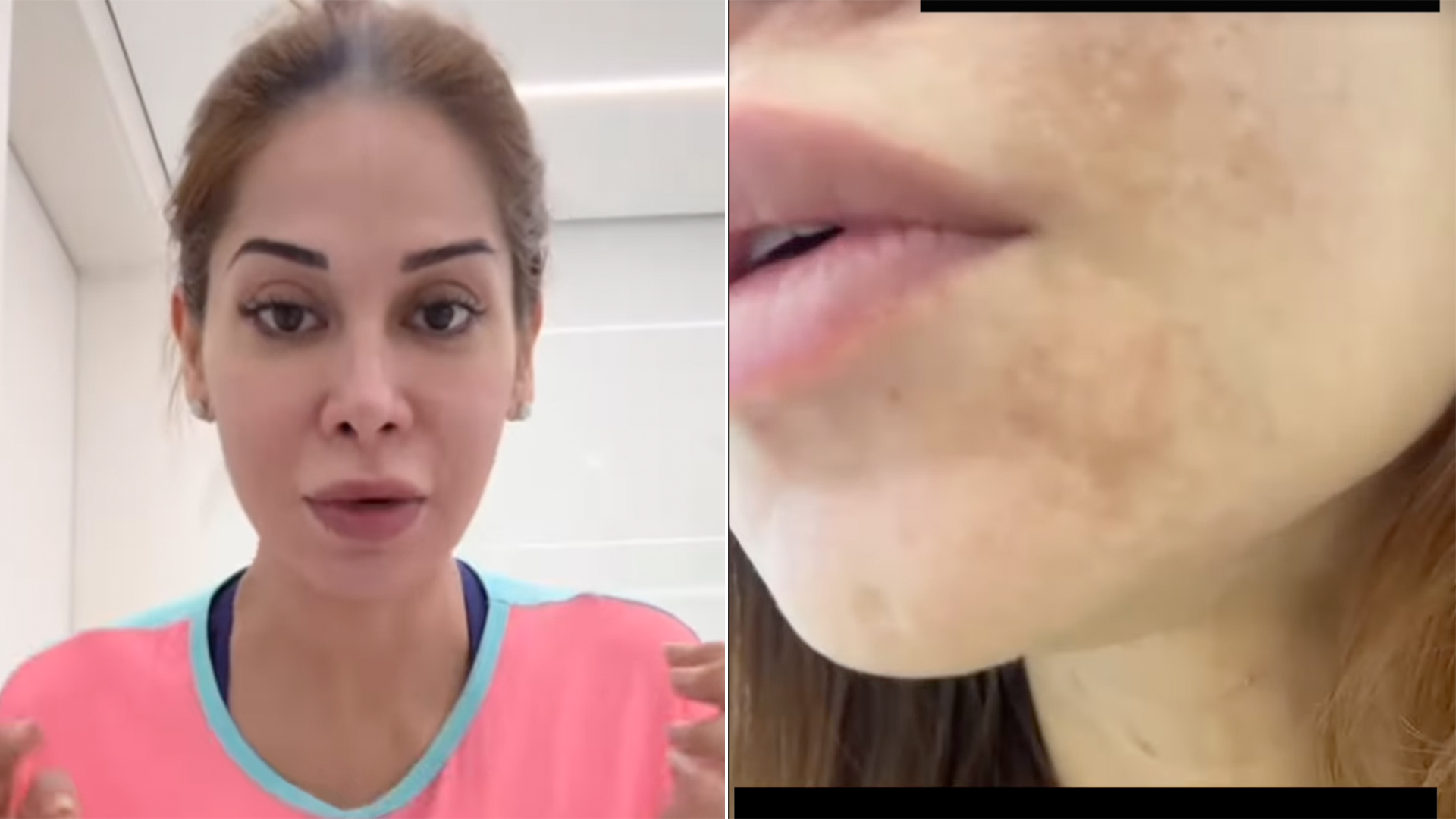 Médico de Maíra Cardi dá dica para tratar melasma na gravidez