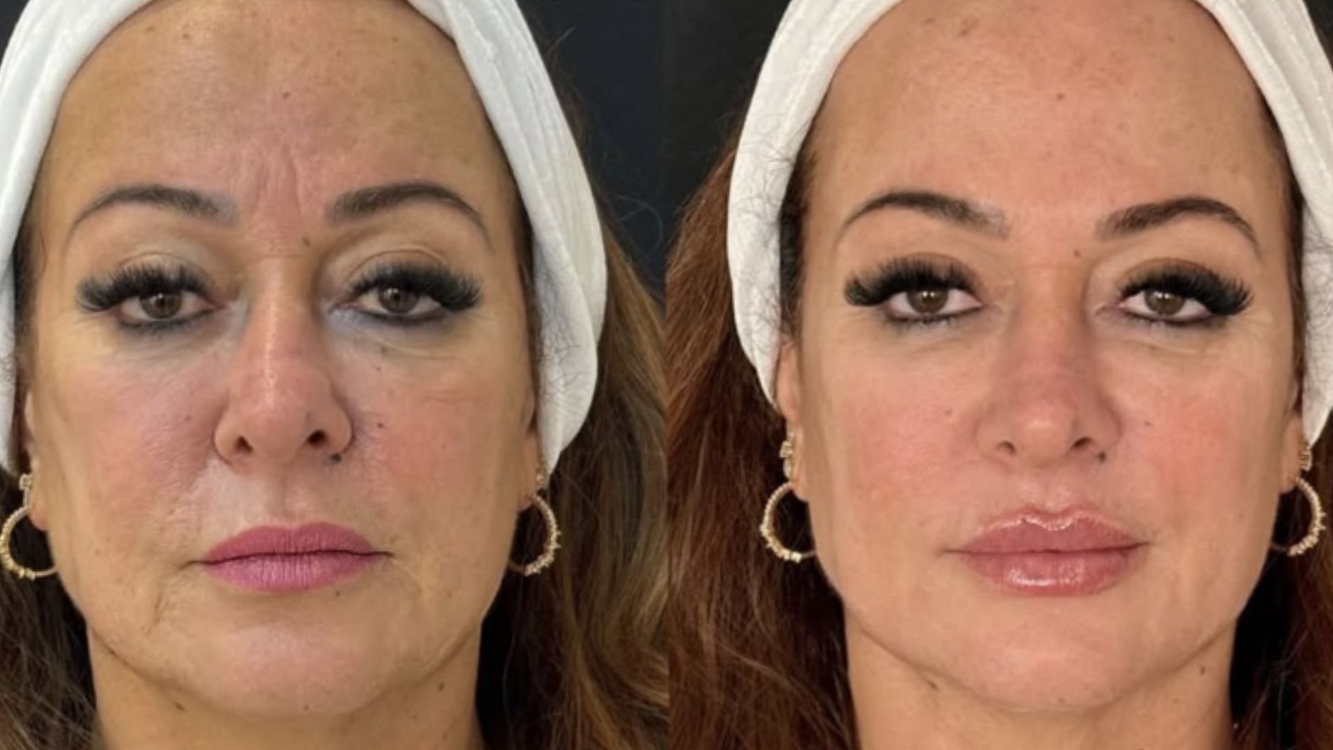 Médica avalia rejuvenescimento de Nadine Gonçalves e aponta segredo: ‘É o que sustenta’
