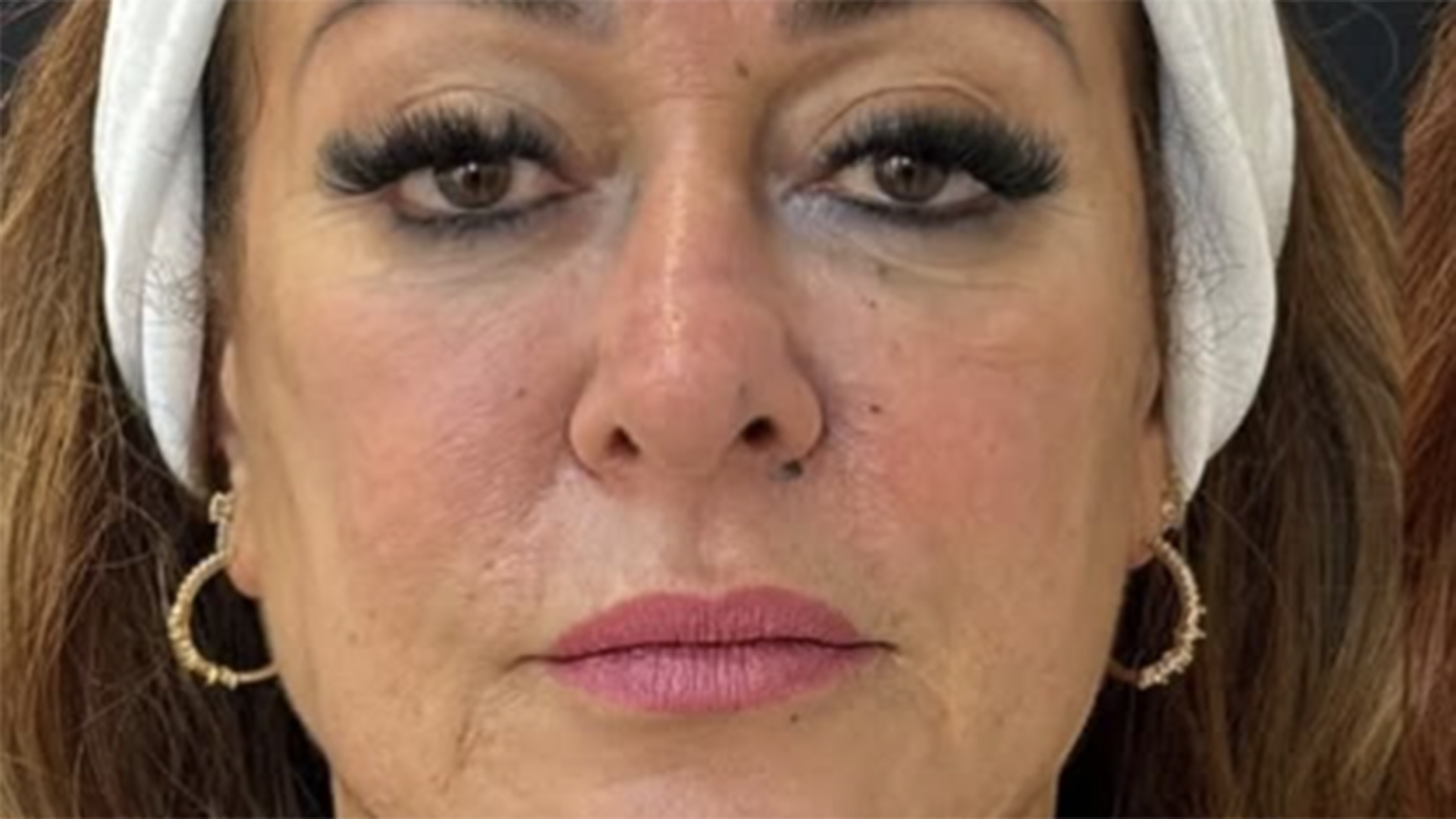 Mãe de Neymar Jr faz tratamento no rosto. Veja antes e depois