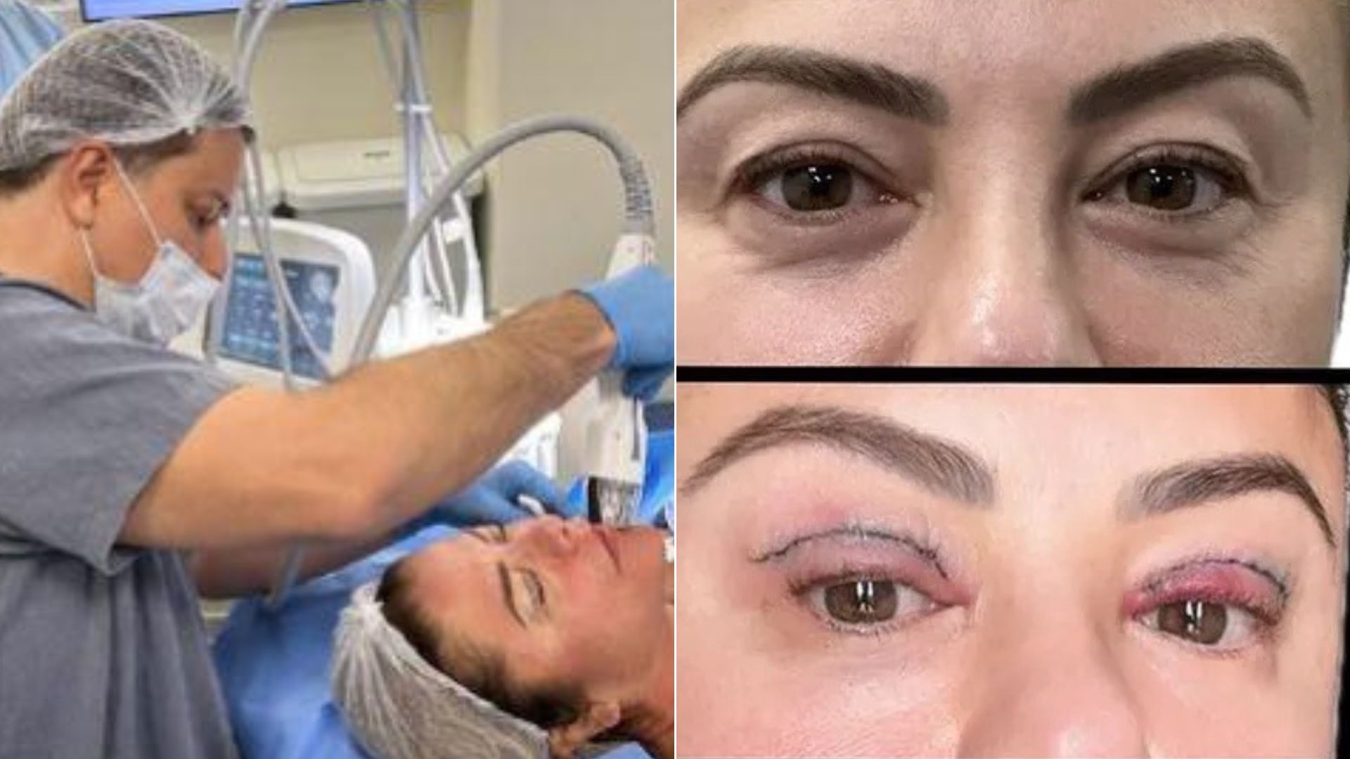 Médico explica como funciona recuperação da cirurgia de Poliana Rocha: ‘Inchaço e hematomas’