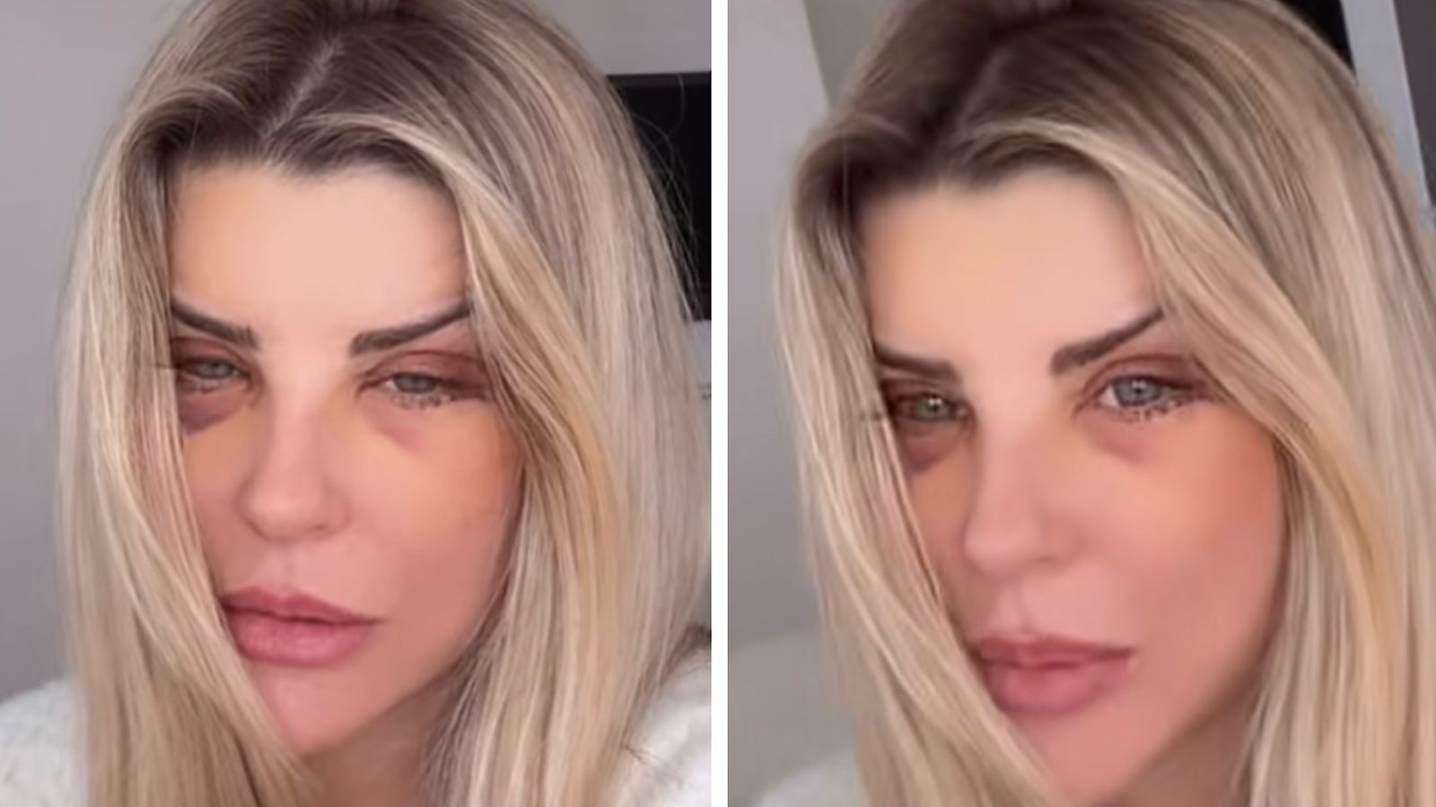 Médico explica cirurgia da ex-BBB Íris Stefanelli: ‘Mudanças logo nos primeiros dias’