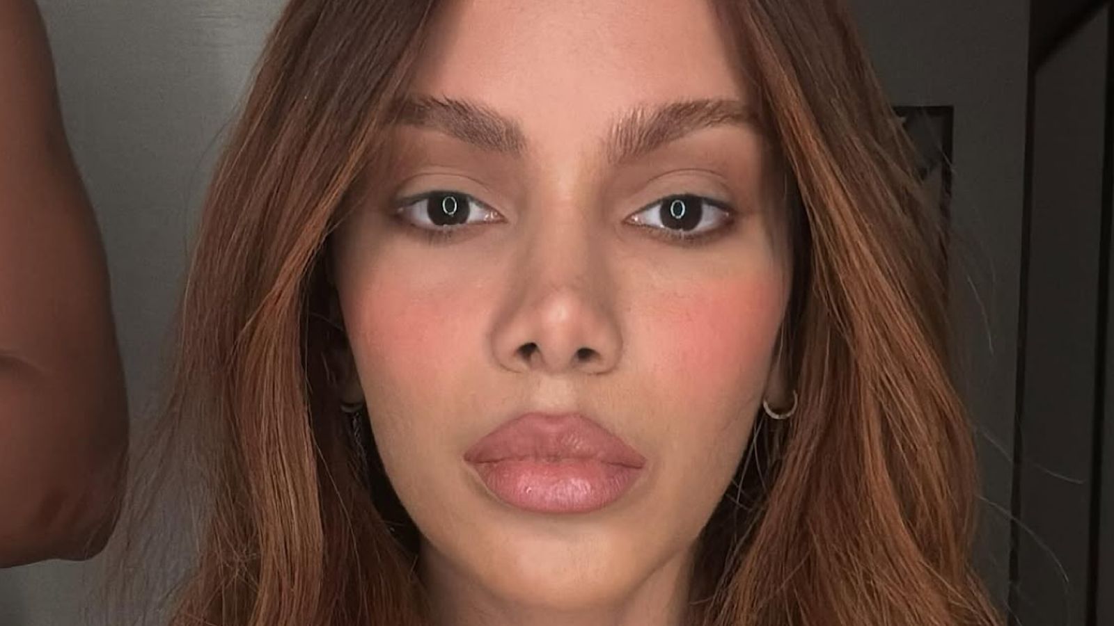 Anitta fez algum procedimento estético? Médico aponta: ‘Nas camadas mais profundas’