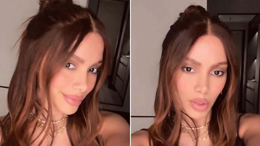 Médico aponta possíveis mudanças no rosto de Anitta: ‘É possível notar’