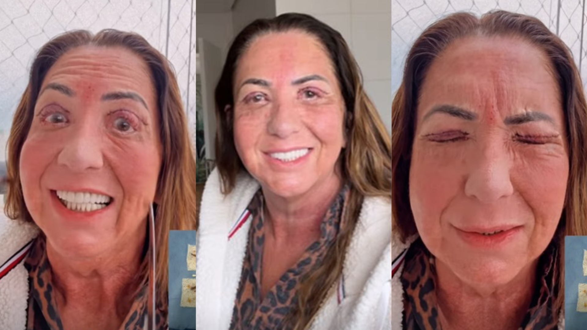 Mãe de Virginia Fonseca passa por cirurgia na região dos olhos e médico alerta: ‘Cuidados’