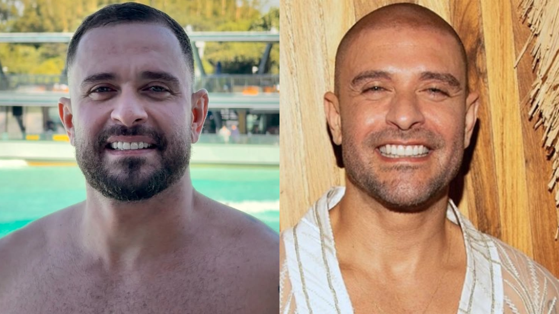 Diogo Nogueira abandona cabeça raspada, e médica aponta: ‘Tudo indica que ele fez’