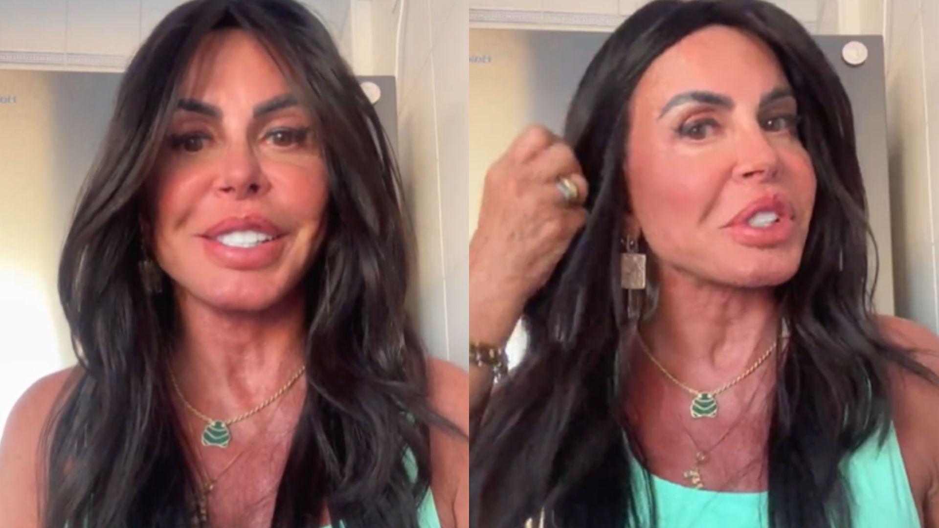 Gretchen renova a harmonização facial e dermatologista comenta: ‘Mais natural’