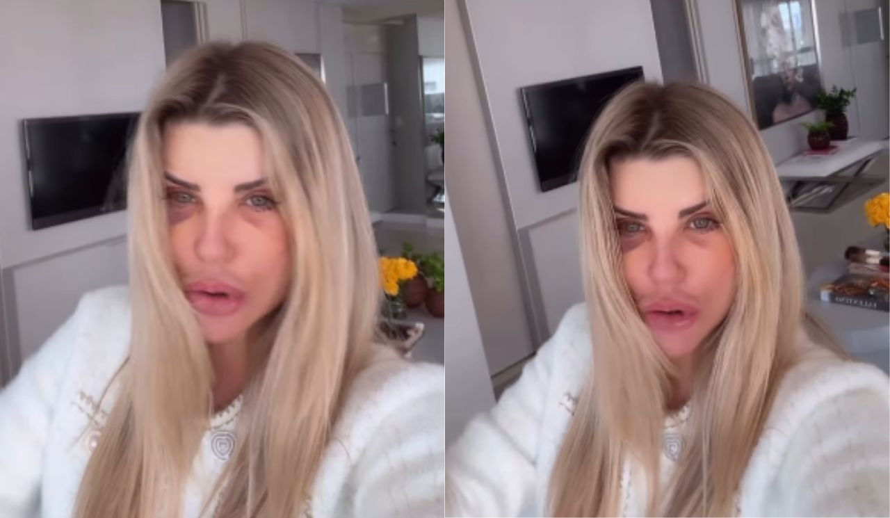 Íris Stefanelli mostra rosto 28 dias após procedimentos estéticos; confira