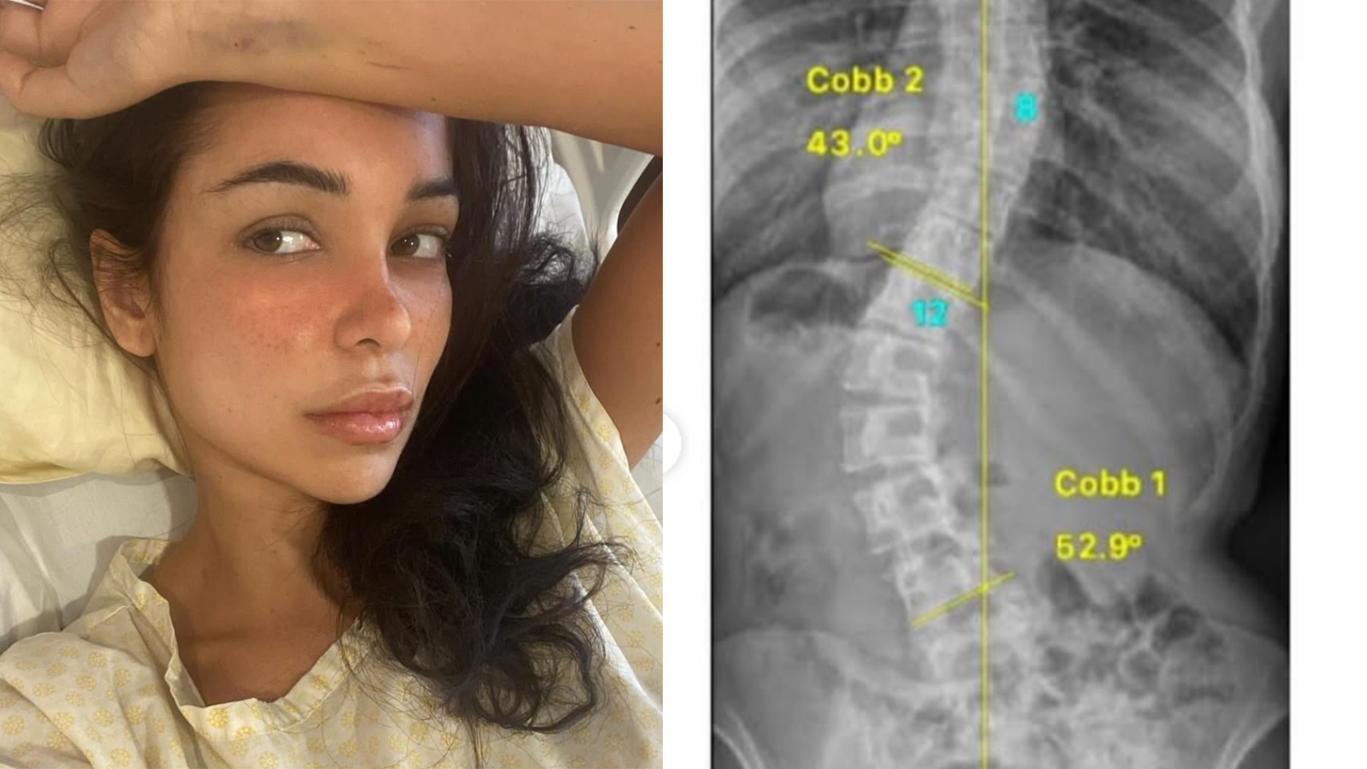 Nora de Victoria Beckham exibe cicatriz gigante nas costas após cirurgia dolorosa