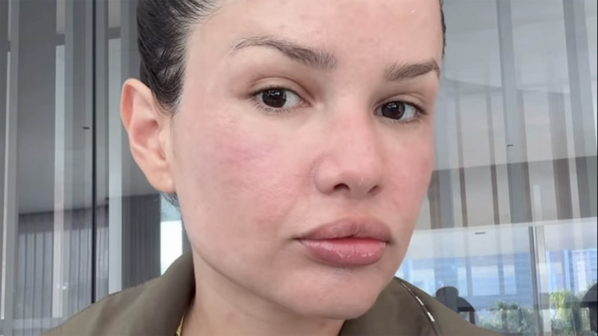 Juliette aparece com o rosto inchado após tratamento estético