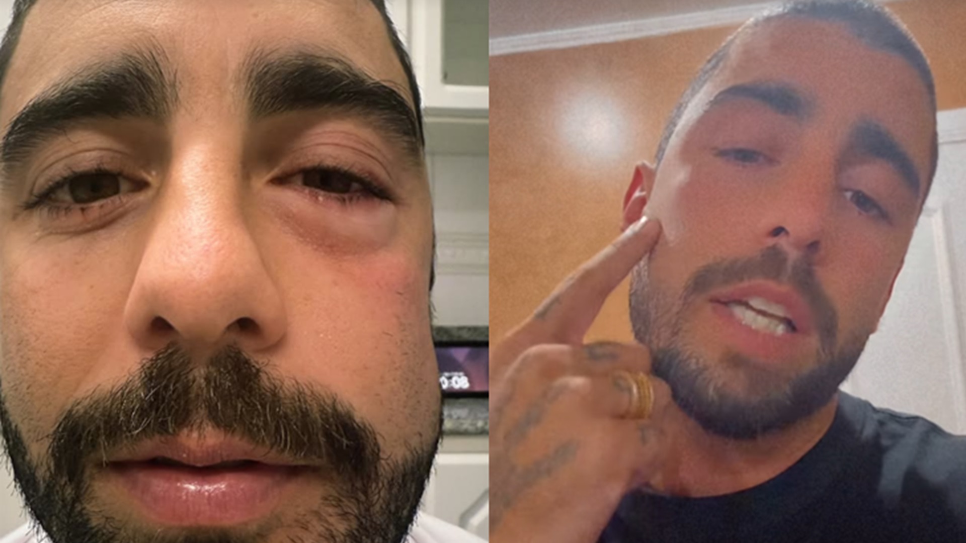 Pedro Scooby surge com o rosto inchado e explica o que aconteceu