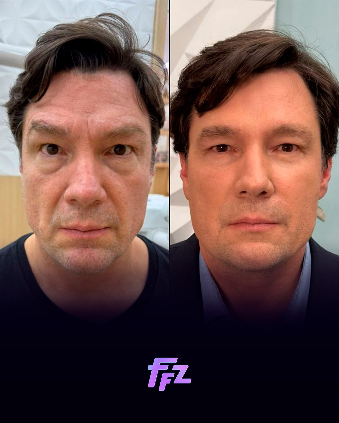 Antes e depois de Ricardo Macchi - Foto: Reprodu&ccedil;&atilde;o / Fofocalizando, SBT