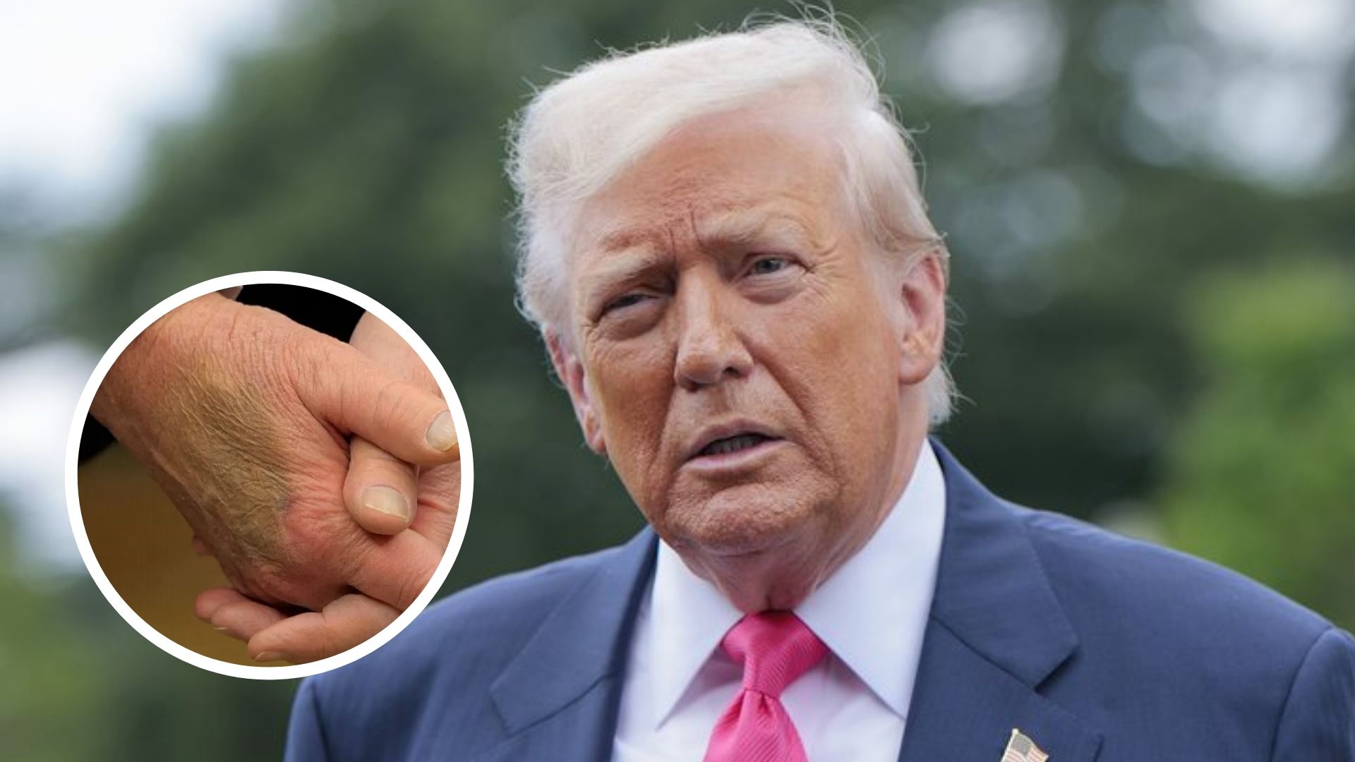 Manchas nas mãos de Donald Trump levantam alerta sobre saúde vascular, aponta cardiologista