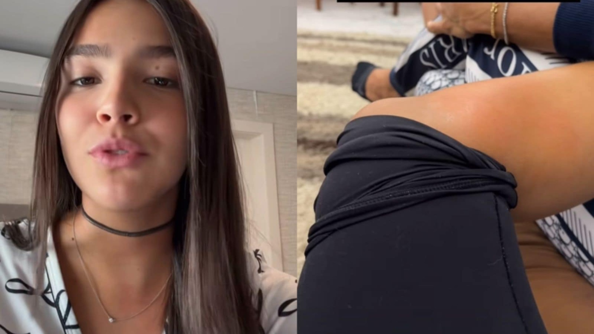 Ex-nora de Angélica, Duda Guerra fala sobre não tirar tumor da perna