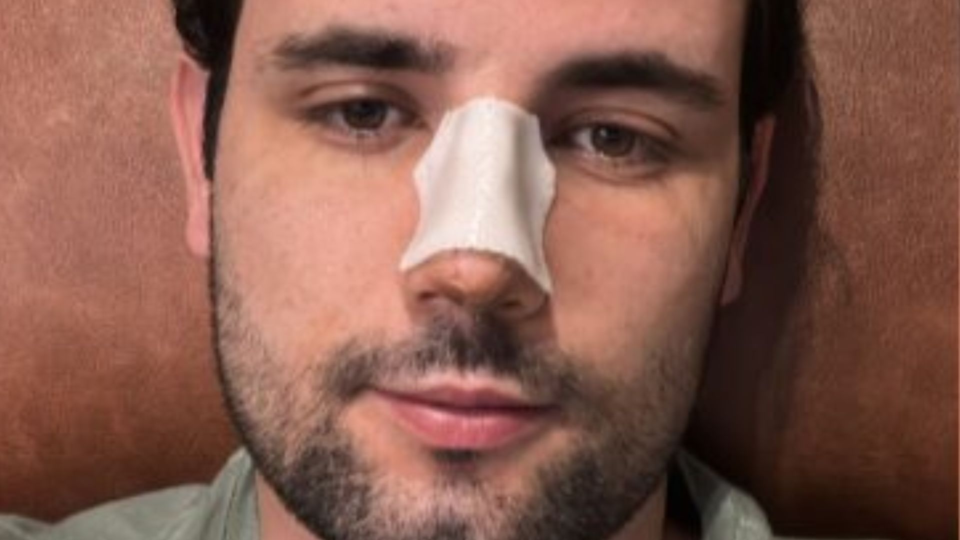 Matteus Amaral revela motivo por trás da rinoplastia