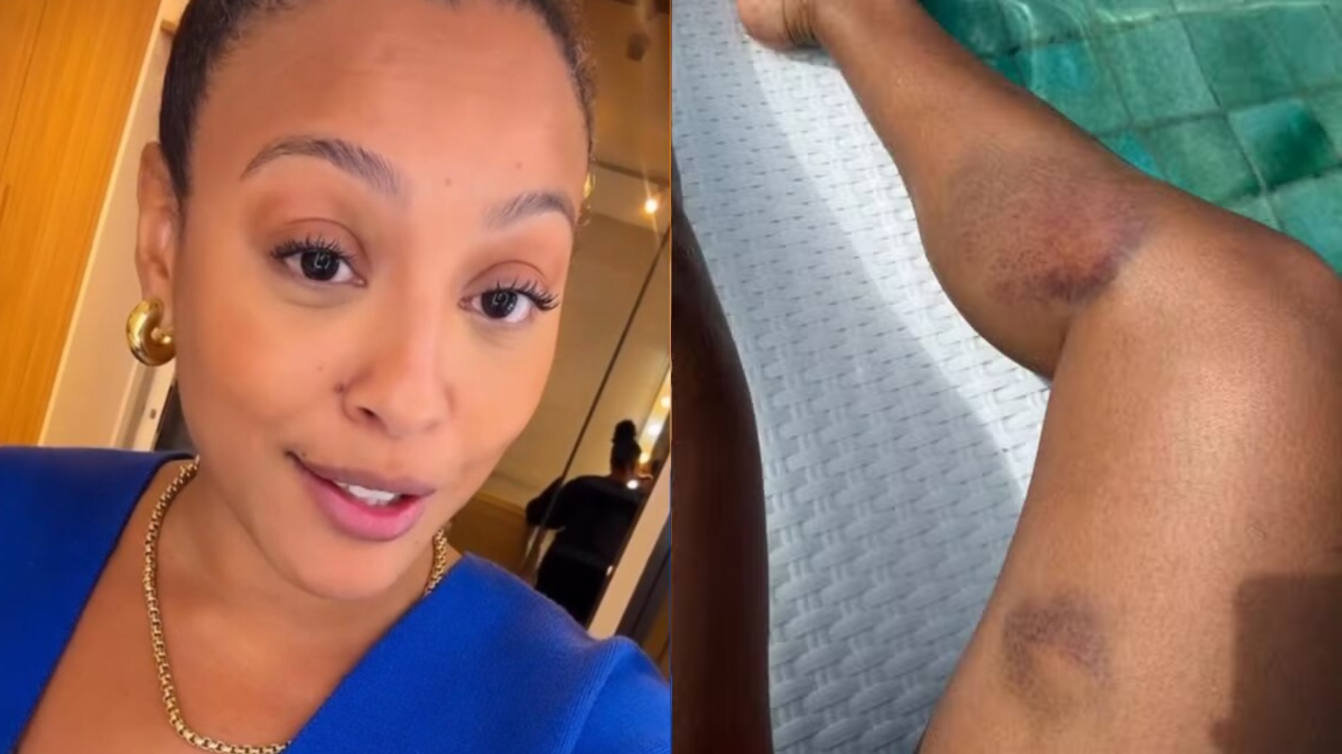 Sheron Menezzes sofre acidente, mostra hematomas e ouve alerta médico: ‘Impacto forte’