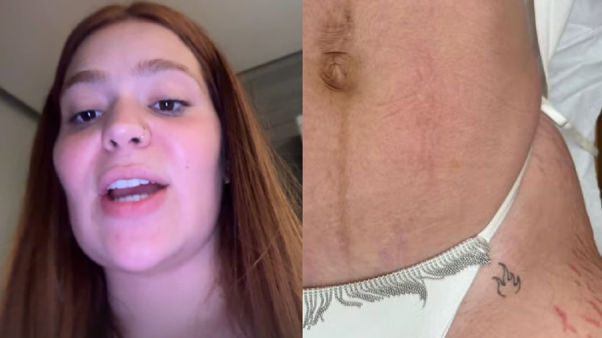 Viih Tube mostra antes e depois de tratamento contra estrias: ‘Funcionou muito’