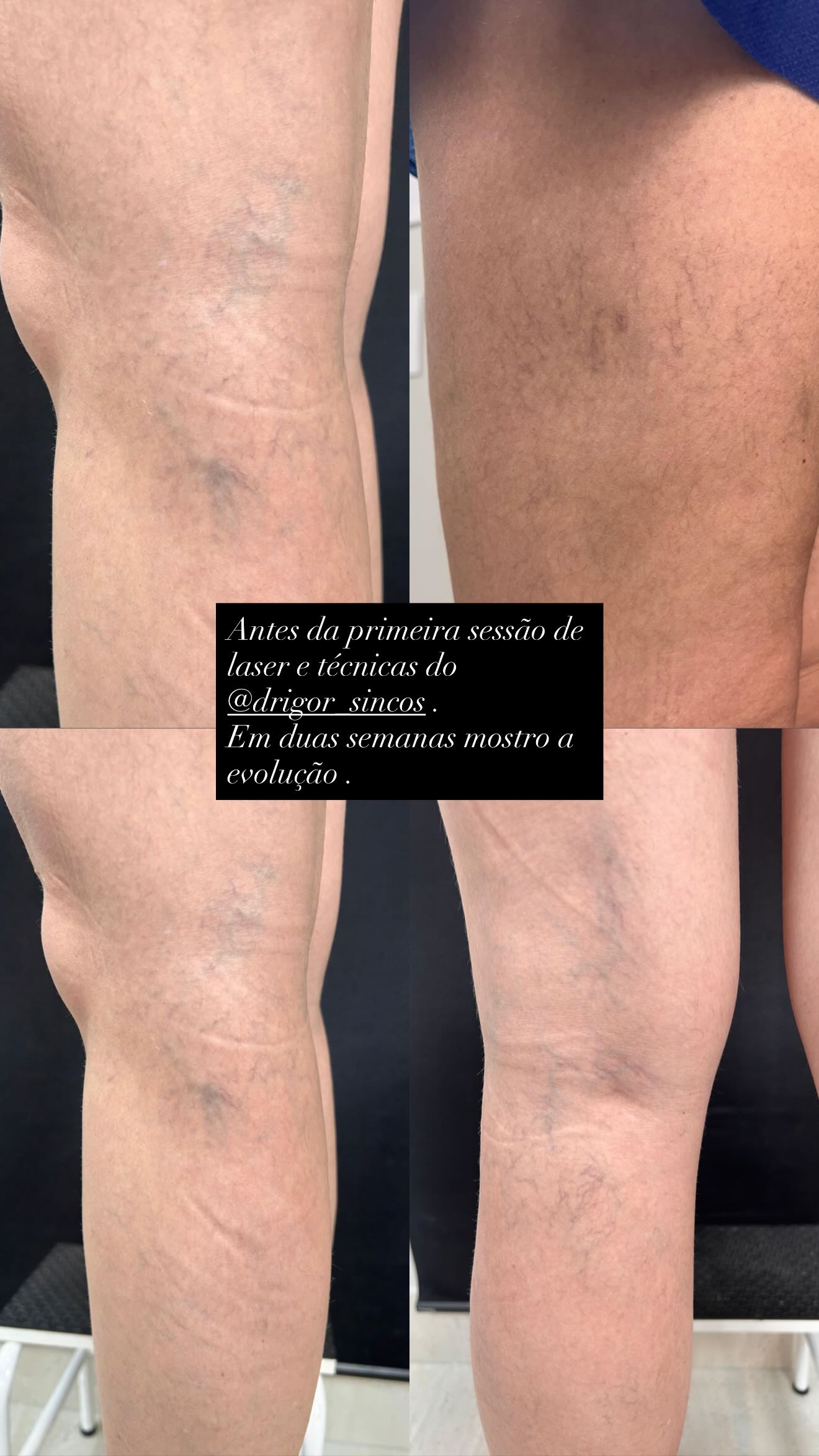 Ana Hickmann mostra como estão suas pernas - Foto: Reprodução @ahickmann