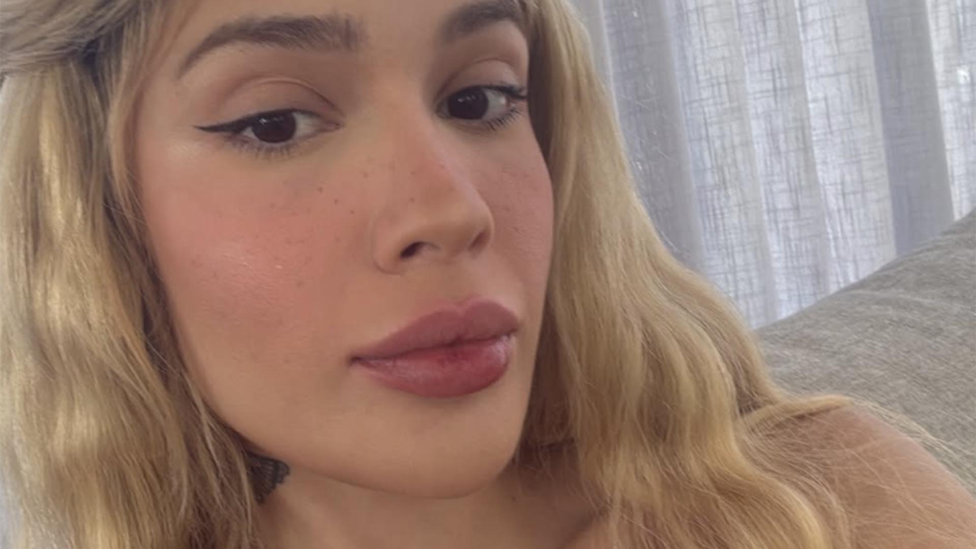 Karoline Lima choca com ‘antes e depois’ de preenchimento que deu errado