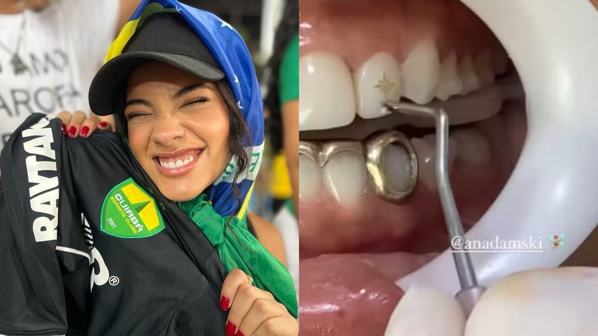 Bella Campos inspira tendência de tooth gems, mas dentista alerta: ‘Danos permanentes’
