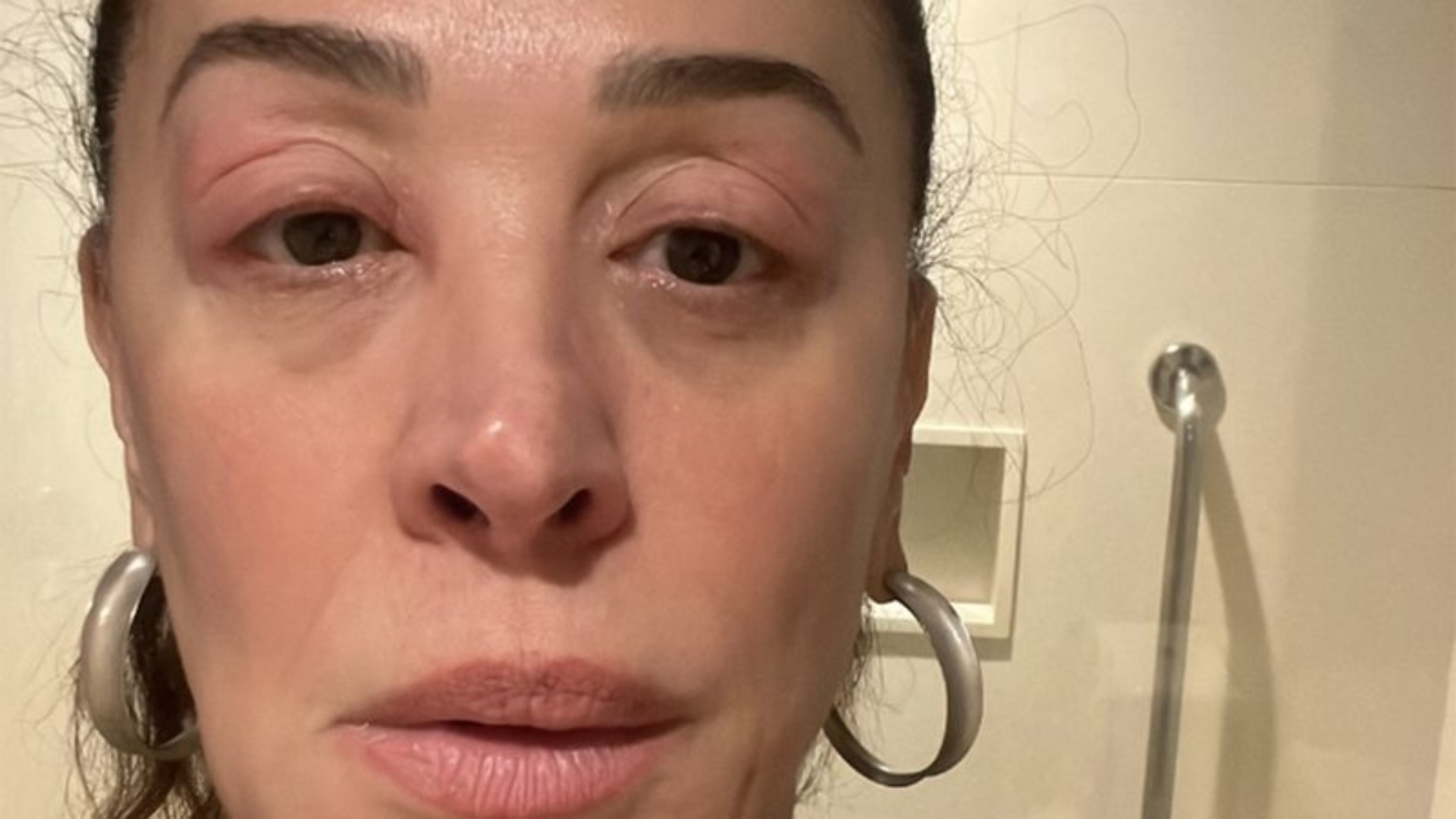 Claudia Raia foi surpreendida por uma reação alérgica preocupante
