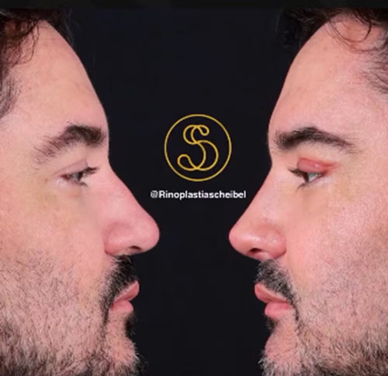 Fernando Zor e Lara Bissi mostram resultados de suas rinoplastias &mdash; Foto: Reprodu&ccedil;&atilde;o/Instagram