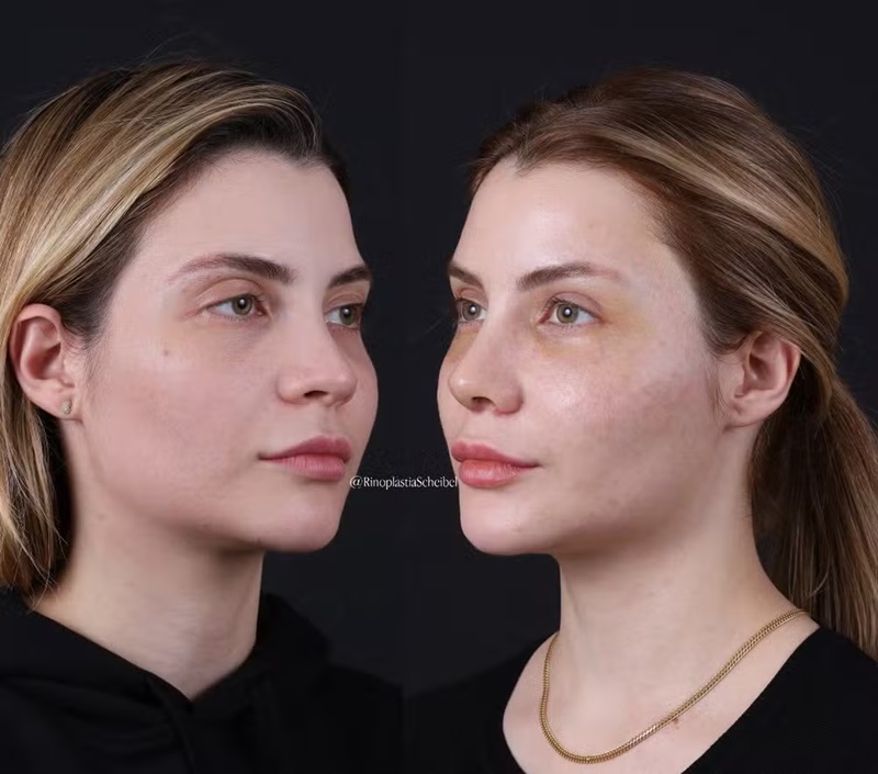 Fernando Zor e Lara Bissi mostram resultados de suas rinoplastias &mdash; Foto: Reprodu&ccedil;&atilde;o/Instagram