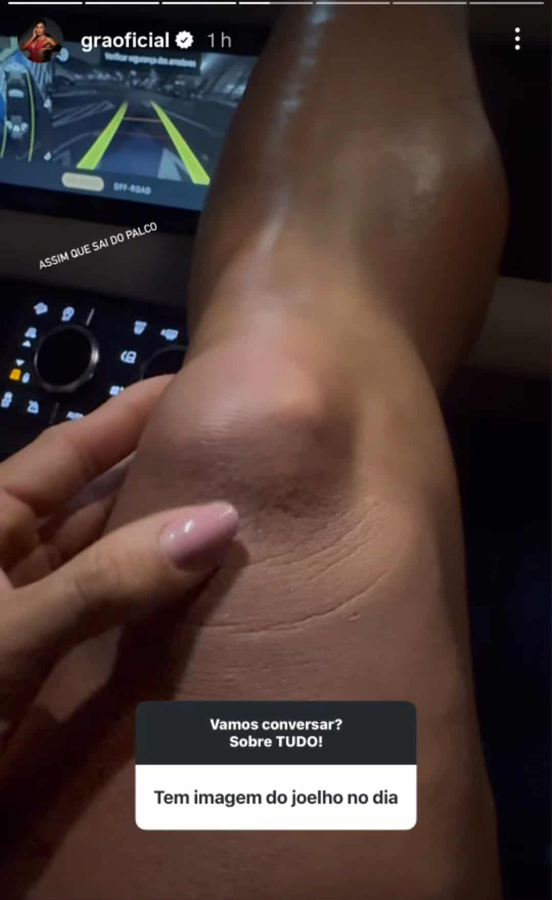 Gracyanne Barbosa mostra como ficou seu joelho após acidente