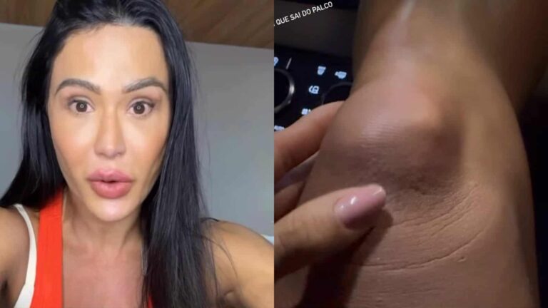 Gracyanne Barbosa mostra como ficou seu joelho após acidente: ‘Bem ruim’