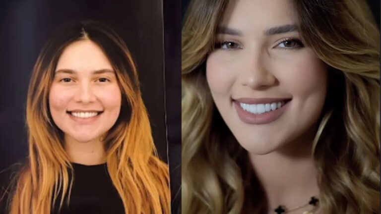 Após moda entre Virgínia Fonseca a Neymar, cresce busca por remoção de lentes dentais, dentista faz alerta