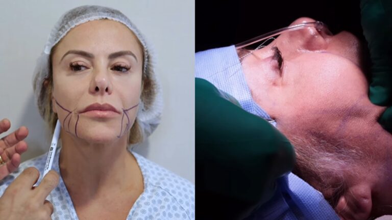 Médico de Poliana Rocha explica os procedimentos estéticos que ela fez: ‘Potencializar’