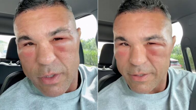 Vitor Belfort fica com o rosto inchado após reação inesperada