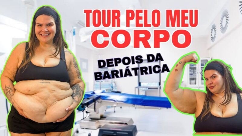 Após perder 75 kg, Thais Carla expõe excesso de pele, e especialista explica riscos