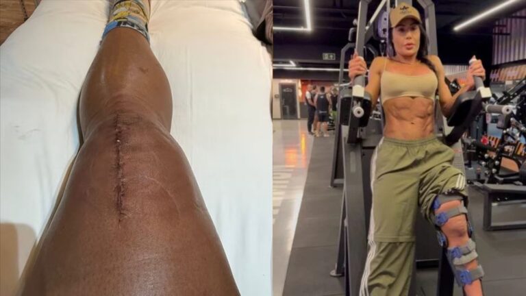 Cicatriz no joelho como a de Gracyanne Barbosa? Médica aponta o que realmente funciona no tratamento