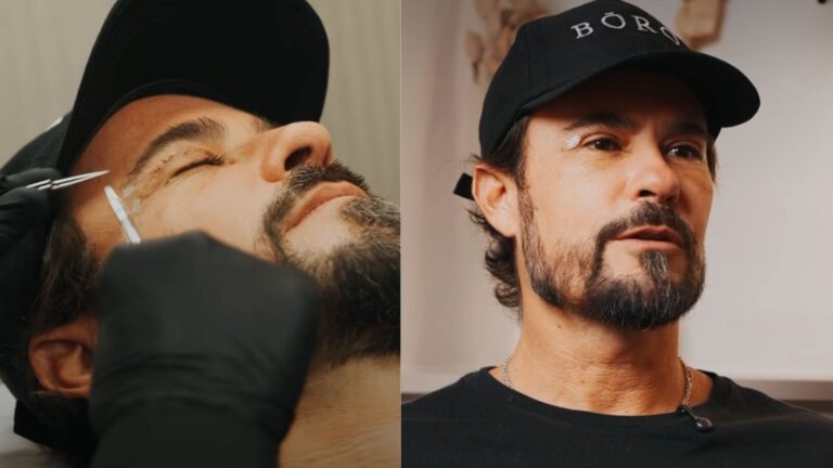 Paulinho Vilhena passa por blefaroplastia e cirurgiã explica o procedimento: ‘Rejuvenescido’