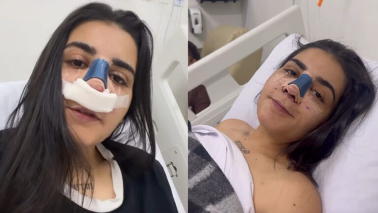 Yasmin Santos mostra o antes e depois de seu nariz após cirurgia plástica; veja