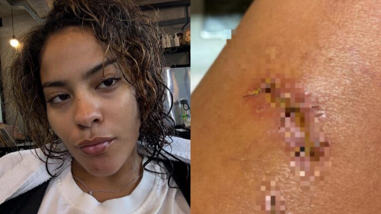 Mordida de jacaré em Bella Campos acende alerta; médico explica gravidade: ‘Bactérias severas’