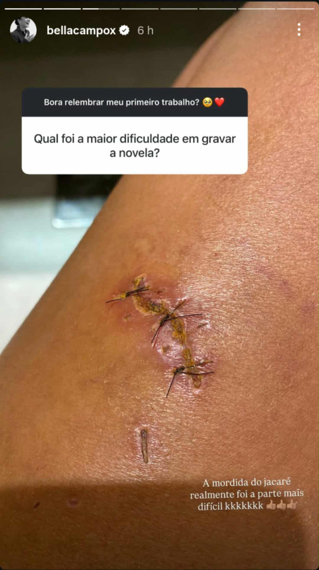 Bella Campos relembra mordida de jacaré