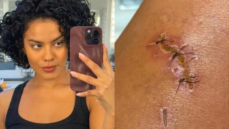 Bella Campos relembra mordida de jacaré - Foto: @bellacampox