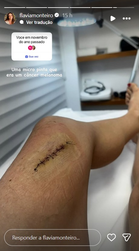 Flávia Monteiro recorda cicatriz de cirurgia de retirada de tumor - Reprodução/Instagram @flaviamonteiro