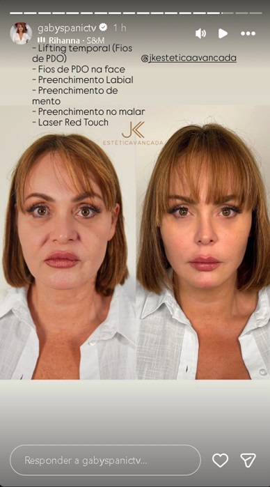 Gaby Spanic, a Usurpadora, mostra antes e depois de seu rosto— Foto: Reprodução/Instagram @gabyspanictv