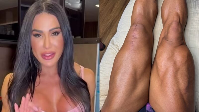 Gracyanne Barbosa reage a comentários sobre cicatriz na perna: ‘Zero preocupação’