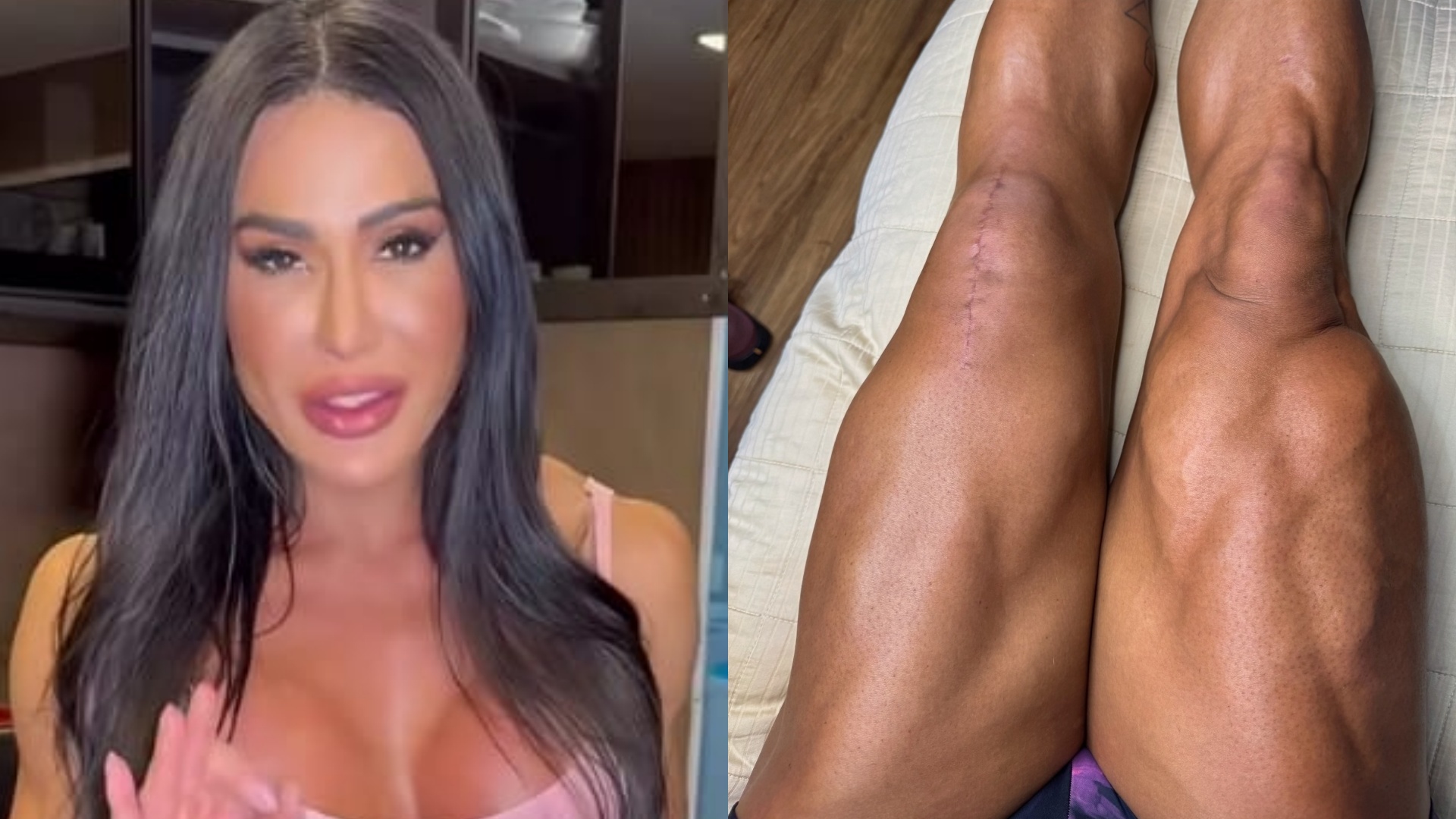 Gracyanne Barbosa fala sobre cicatriz