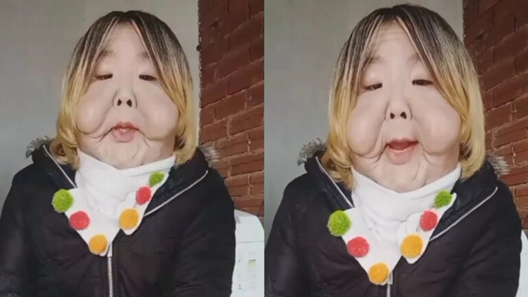 Influenciadora passa por cirurgia após ter rosto deformado por procedimento