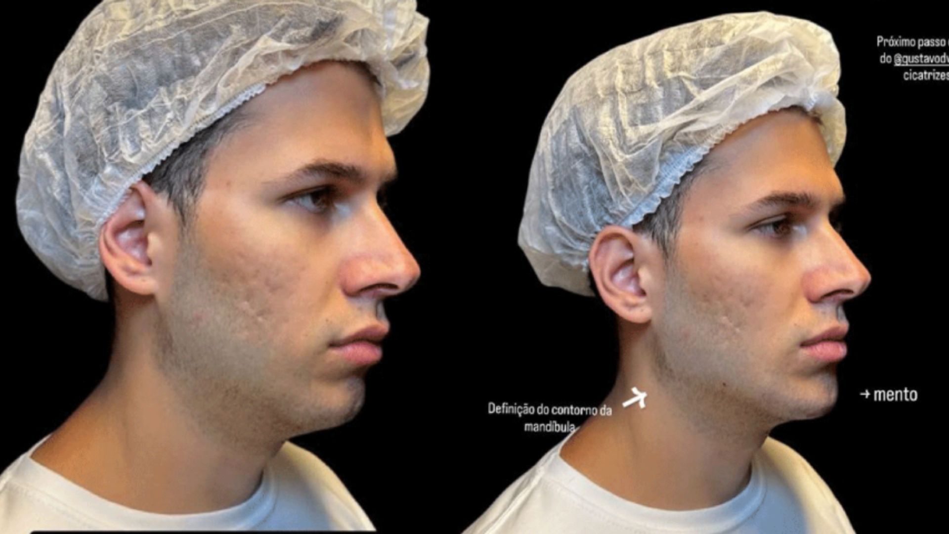 João Gustavo, antes e depois - Fotos: Reprodução/Instagram
