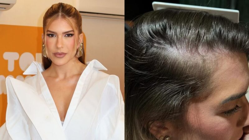 Lore Improta revela resultado de tratamento para alopecia; veja antes e depois
