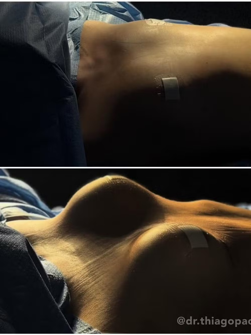Maressa Lopes mostra resultado de cirurgia — Foto: Reprodução/Instagram @maressalopes_