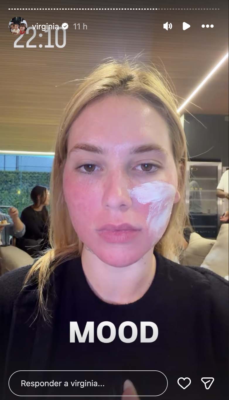Virginia mostra sua aparência após passar por tratamento com laser - Foto: Reprodução / Instagram