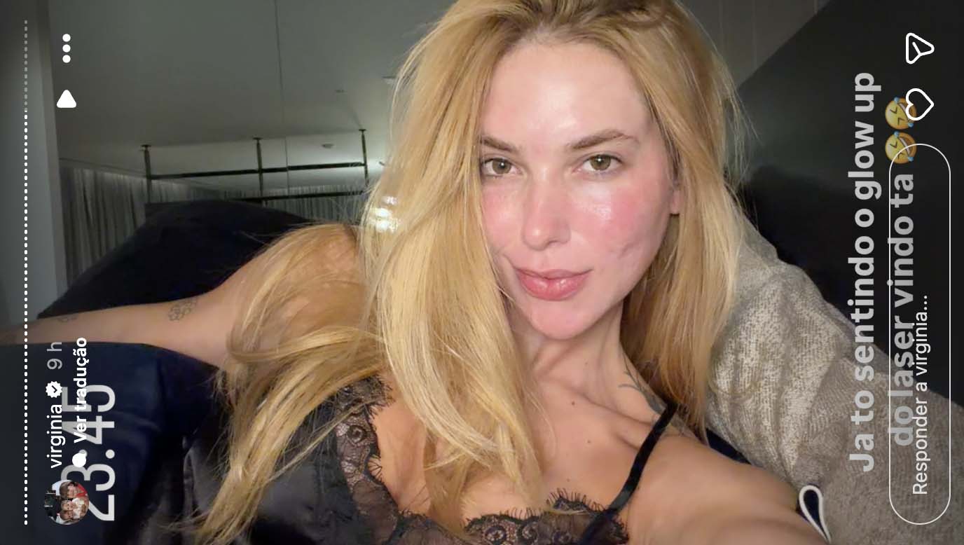 Virginia mostra sua aparência após passar por tratamento com laser - Foto: Reprodução / Instagram